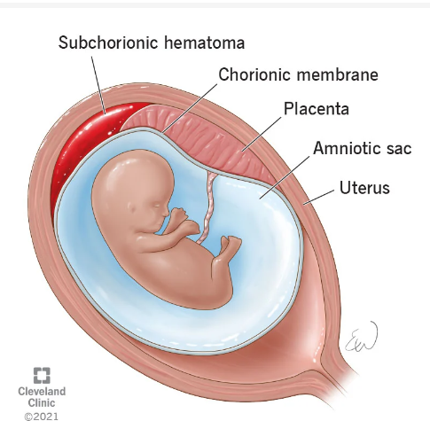 A CASE OF SUBCHORIONIC HEMATOMA AND FEEBLE HEARTBEAT MANAGED WITH CLASSICAL HOMOEOPATHIC TREATMENT article cover image